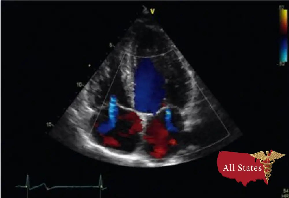 GE Vivid E9 XDClear Refurbished with 3 Probes