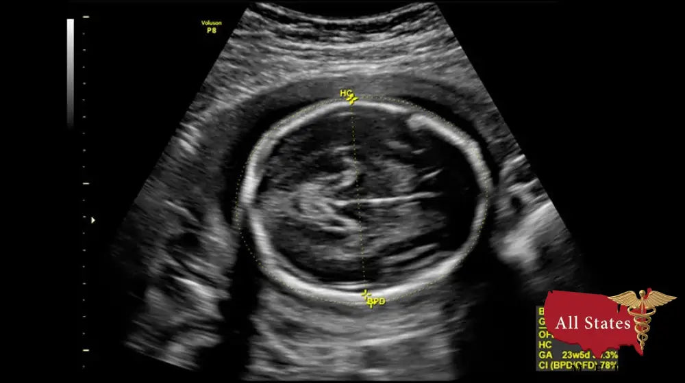 GE VOLUSON P8 BT16 Refurbished WITH 3 Probes