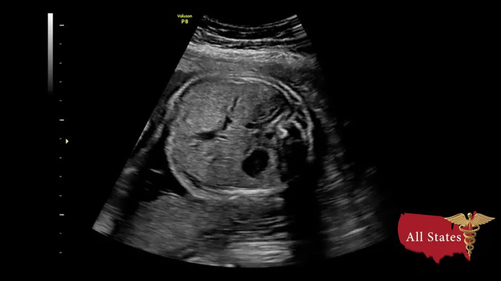 GE VOLUSON P8 BT16 Refurbished WITH 3 Probes