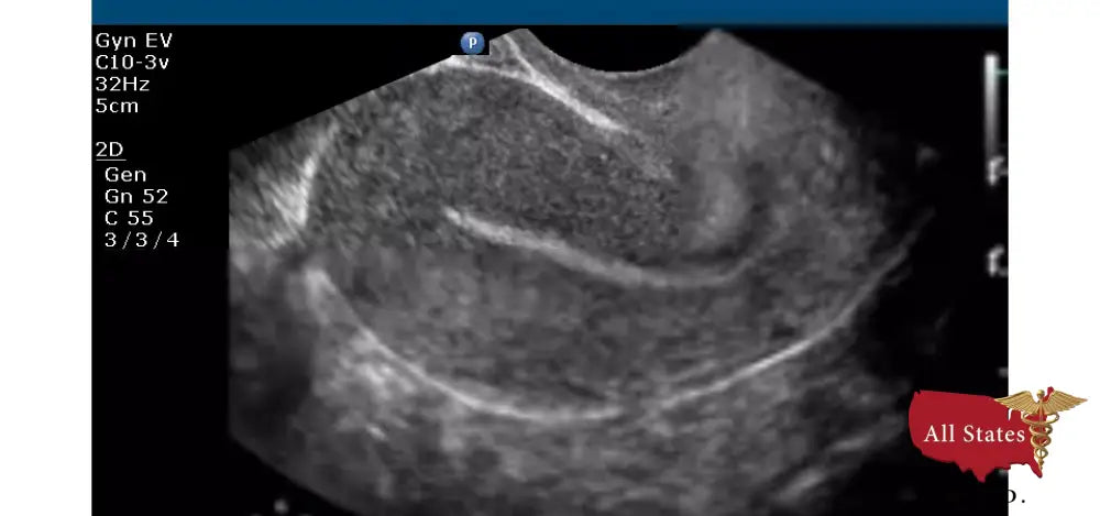 Philips CX50 Refurbished with 3 Probes